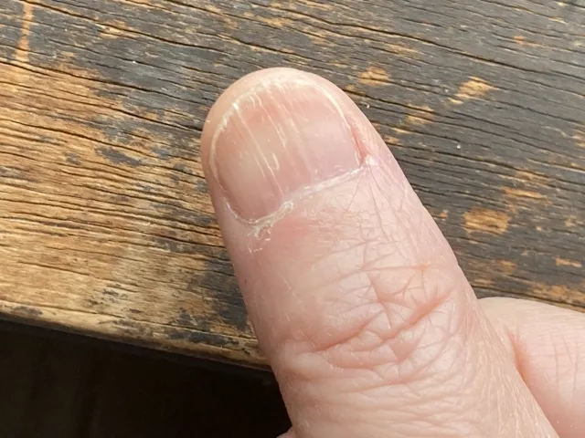 爪の表面が痛い原因は？自分でできるケア方法と病院へ行くべき症状を解説